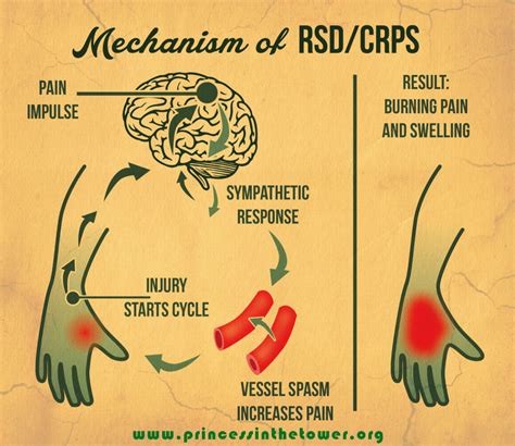 Complex Regional Pain Syndrome CRPS/RSD | The Princess in the Tower