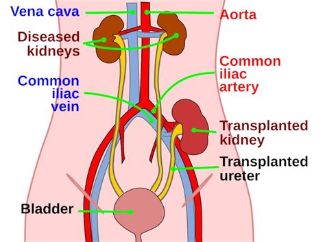 Kidney Transplantation | Credence Medicure Corporation | Telemedicine ...