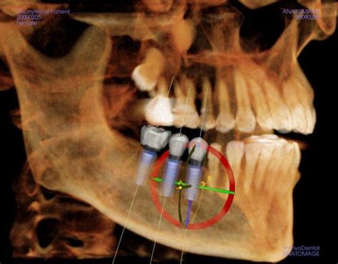 The Ultimate Guide to Dental Implant Surgery - StoneCreek Dental Care