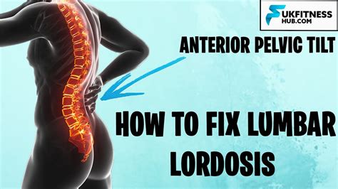 Swayback Lordosis