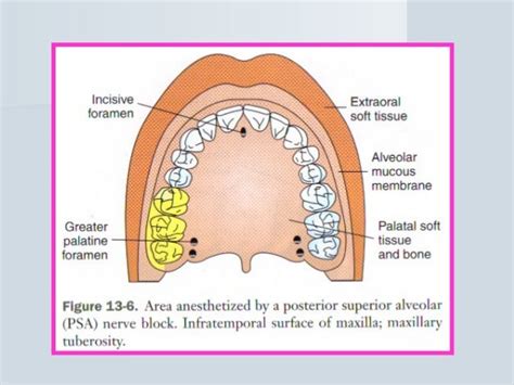 Posterior superior alveolar (psa) nerve block