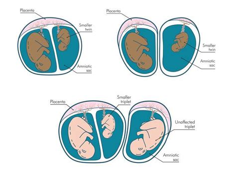 Fraternal Twins Fetal Development