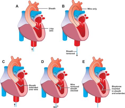 Endomyocardial Biopsy | Thoracic Key