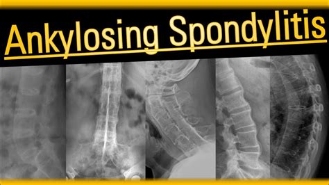 Ankylosing Spondylitis #arthritis #radiology #bones - YouTube