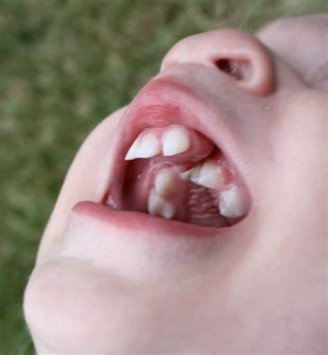 Cleft Lip, Cleft Palate - Pediatric Dental Care Tips