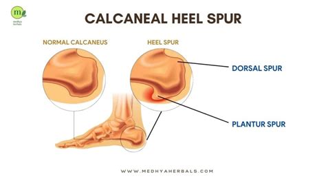 Heel Spur Treatment: The Best Ayurvedic Remedies for Pain