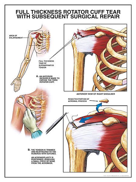 Shoulder Injuries from Slip and Fall Accident Result in Significant Pain and Suffering Award ...