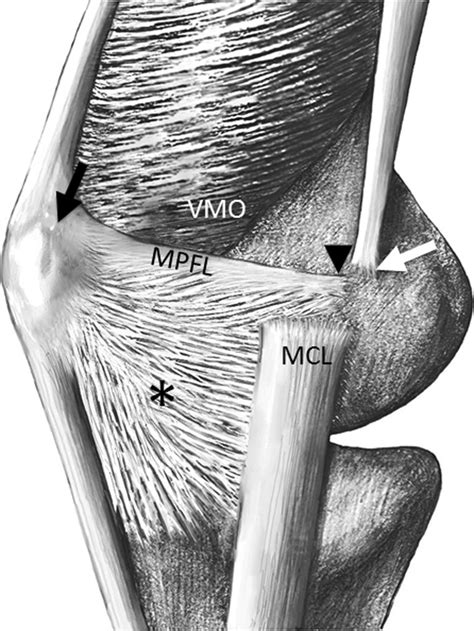 Medial stabilizing soft-tissue structures of the knee. The medial... | Download Scientific Diagram