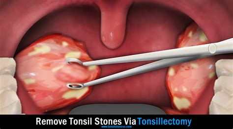 Tonsil Stones Removal Guide [2022]