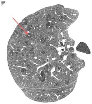 Decreased Lung Attenuation: Emphysema, Mosaic Perfusion, and Cystic Lung Disease | Radiology Key