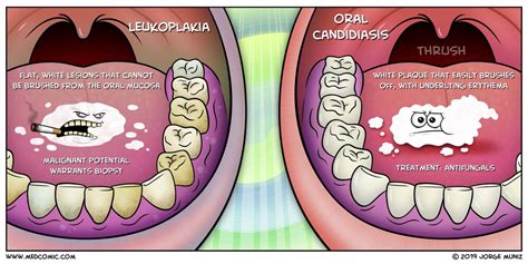 Normal Tongue Vs Thrush