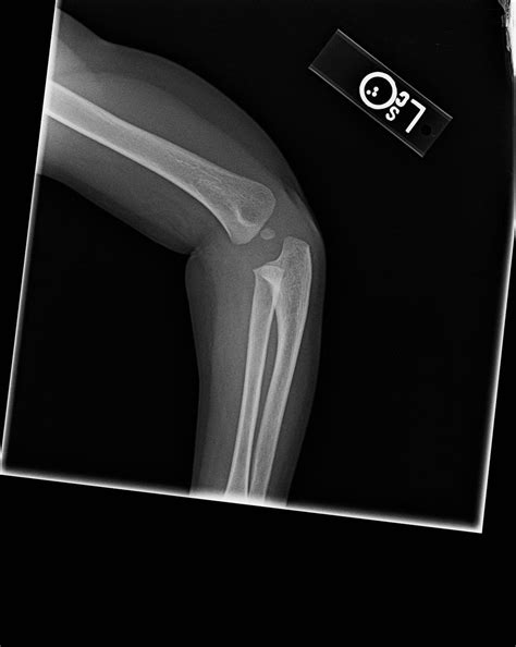 Nursemaid's Elbow - Pediatrics - Orthobullets