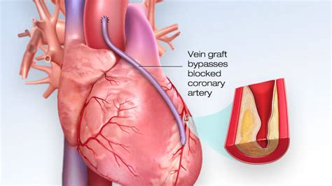 Coronary artery bypass surgery - Procedure & recovery | Meril Life