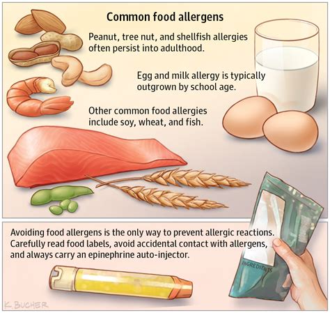 Treatments for Food Allergies JAMA. 2017;318(19):1945. doi:10.1001/jama.2017.17306 | Common food ...