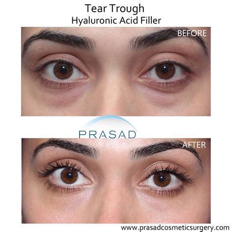 Under Eye Filler Before and After Photos - Prasad Cosmetic Surgery NY