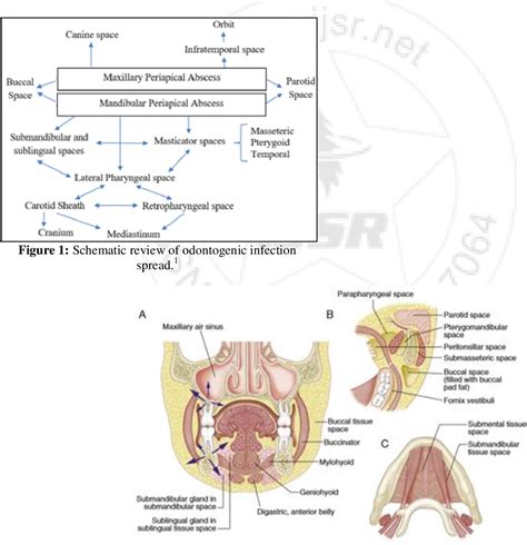 Figure 1 from Life-Threatening Complications of Odontogenic Infection (Literature Review ...