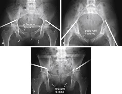 Imaging of the Pelvis and Hip | Radiology Key