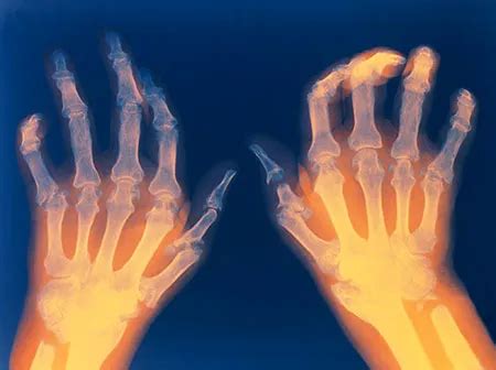 Rheumatoid Arthritis (RA): Signs, 4 Stages, Causes, Treatment & Diet