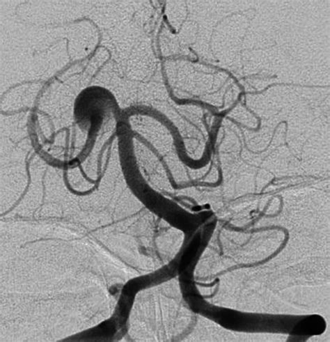 PCA Aneurysm Incorporating Parent Vessel in the Aneurysm Neck ...