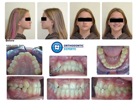 1.Elastics | Top Orthodontist: Braces, Invisalign