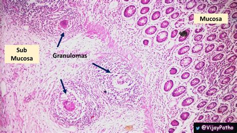 Intestinal Tuberculosis - Pathology Made Simple