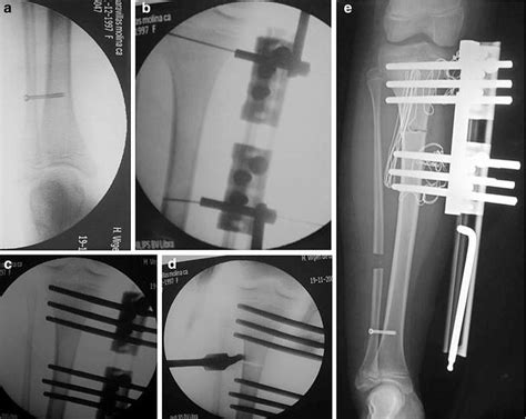 Syndesmotic screw, b locations for the most proximal and distal screws,... | Download Scientific ...