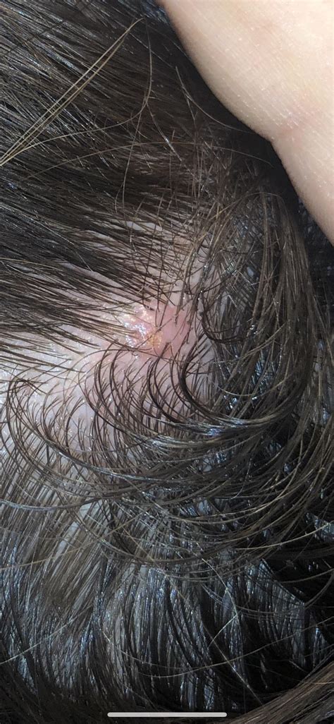 Bump on scalp that won't go away? : r/popping