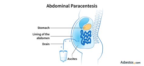 Paracentesis for Mesothelioma | Alleviate Cancer Symptoms