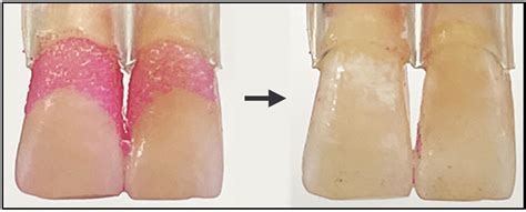 A shape-shifting robotic tooth-cleaner might one day brush for you