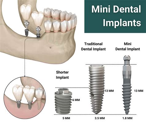 Mini Dental Implants in NJ - Riverside Oral Surgery