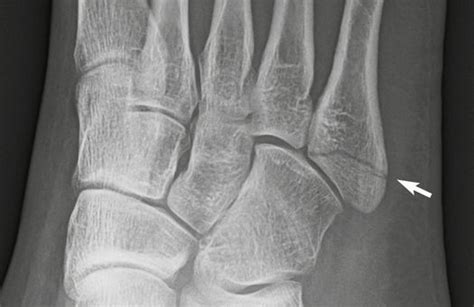 Tendon Avulsion Fracture