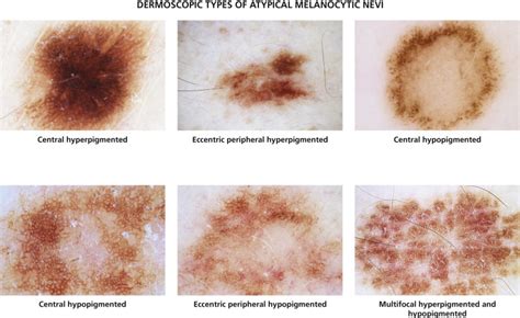 Nevi and Malignant Melanoma | Plastic Surgery Key