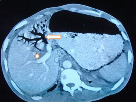 Portal vein air embolism | British Journal of Medical Practitioners