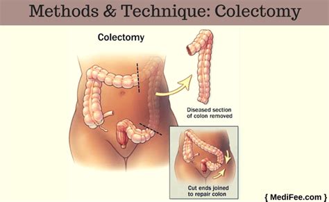 Colorectal Cancer Treatment: Surgery Procedure, Preparation, Risks and Complications