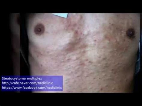 Steatocystoma multiplex - 다발성 피지낭종 - YouTube