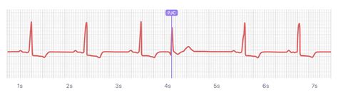 What Premature Junctional Contraction (PJC) Looks Like on Your Watch ...