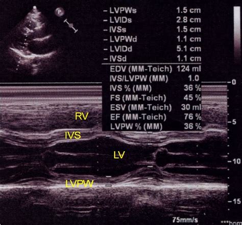 M-Mode Echocardiographic Measurements – All About Cardiovascular System and Disorders