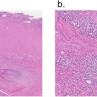 Reported cases of colocutaneous fistula after open tension-free... | Download Scientific Diagram