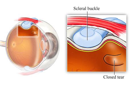 Scleral Buckling Surgery | Ophthalmology