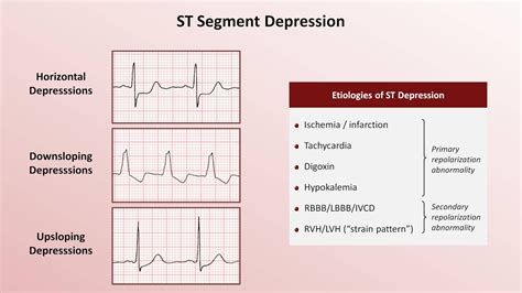 Intro to EKG Interpretation - QRST Changes - YouTube