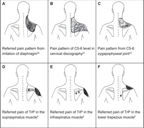 Several possible etiologies in the diagnosis of chronic shoulder pain. | Download Scientific Diagram