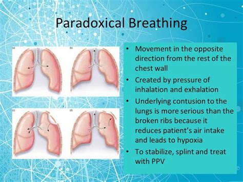 Paradoxical breathing - MEDizzy