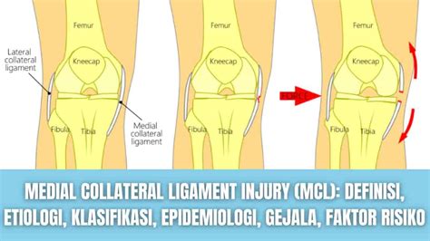 Medial Collateral Ligament Injury (MCL): Definisi, Etiologi ...