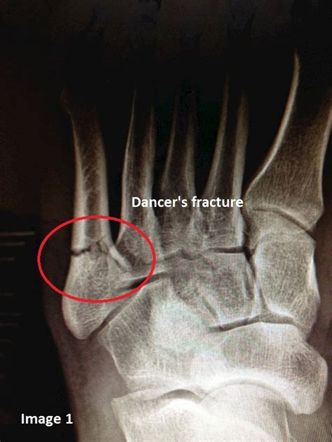 5th Metatarsal Fracture Symptoms