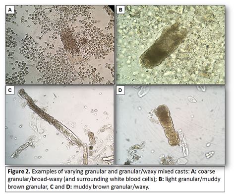 Urine Sediment of the Month: Mixed, Acellular Casts - Renal Fellow Network