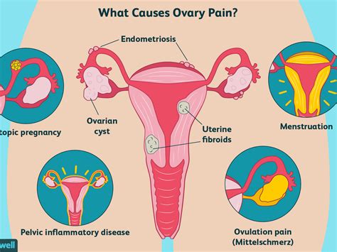 Difference Between Ovulation Pain And Appendicitis