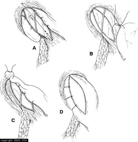 Fundamentals: Cardiomyotomy (Heller Myotomy) Archives - SAGES