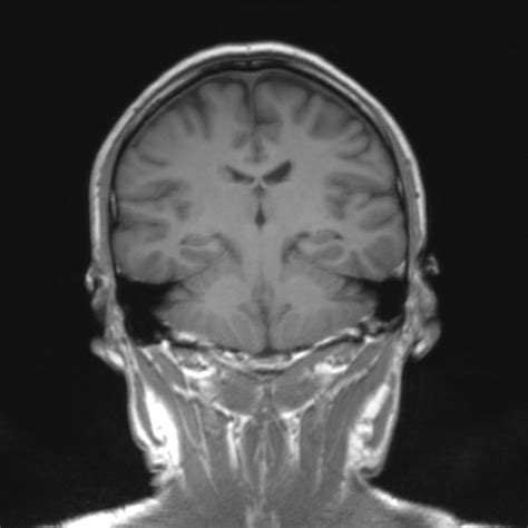 Normal Brain Mri