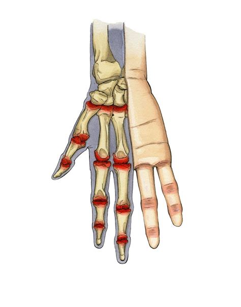 Arthritis of the hands - medical illustration Yoga For Arthritis, Inflammatory Arthritis ...