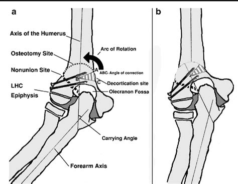 Figure 1 from Triple management of cubitus valgus deformity ...